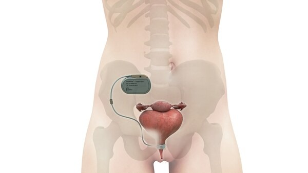 "UroActive smart implant for stress urinary incontinence"